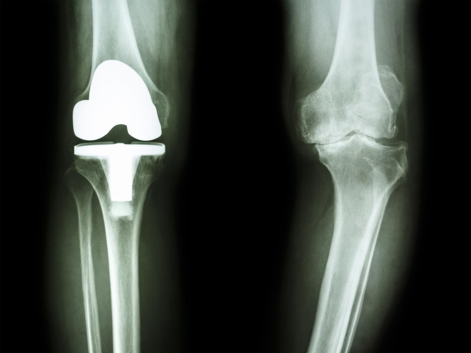 人工膝関節手術後のリハビリ